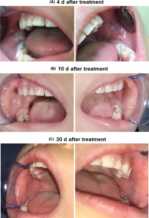On‐site Treatment Of Oral Ulcers Caused By Cheek Biting A Minimally
