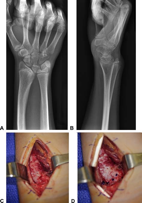 Madelung Deformity Journal Of Hand Surgery