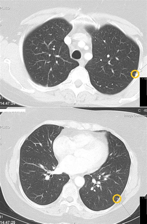 Solitary Pulmonary Nodule Ct Scan Wikidoc