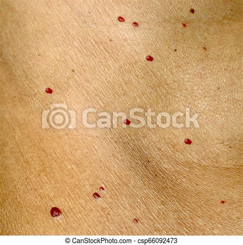 Angioma On The Skin Red Moles On The Body Many Birthmarks Angioma On