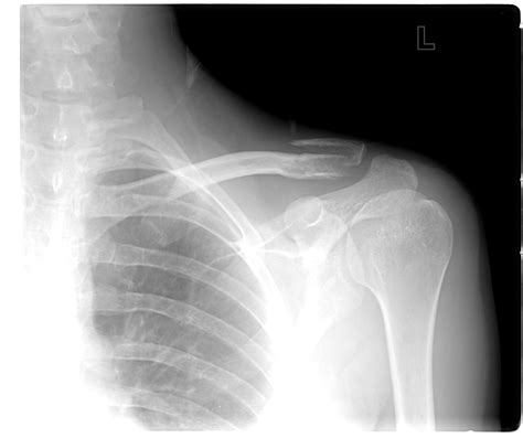 High Left Clavicle Fracture Surgery Required X Rays Included