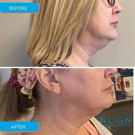 Double Chin Removal And Jowl Treatments With Agnes Rf Align Injectable Aesthetics