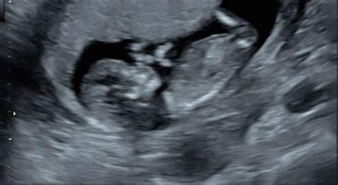 How To Tell Gender On Ultrasound 13 Weeks