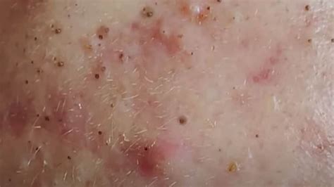 The Most Pleasing Blackhead Popping Video