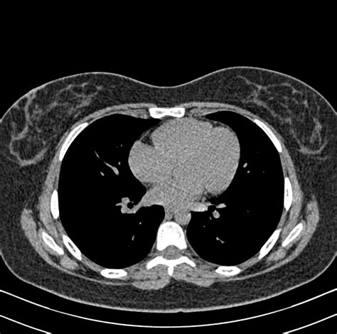 Normal Chest Ct Image