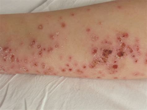Worsening Atopic Dermatitis In A 3 Year Old Boy