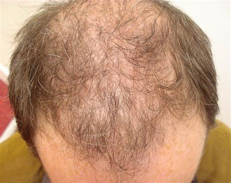 Male Hair Loss Hairmedic