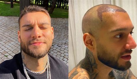 Kulüple 3 yıllık anlaşma imzaladığım için çok mutluyum. 6 famosos que fizeram transplante capilar; Veja resultado