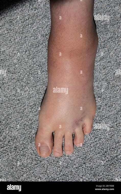 Severe Swelling And Hematoma Of The Left Foot After Bending And
