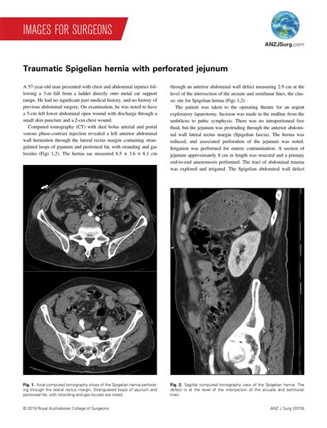 Pdf Traumatic Spigelian Hernia With Perforated Jejunum Images For