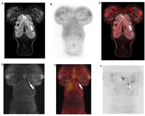 Staging Performance Of Whole Body Dwi Petct And Petmri In Invasive