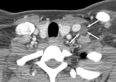 Normal Ct Appearance Of The Distal Thoracic Duct Ajr
