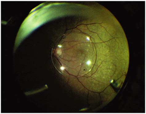 A Nonhaptic Large Diameter Unfoldable Intraocular Lens Dislocated