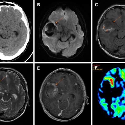 Brain Computed Tomography And Magnetic Resonance Imaging Showed A