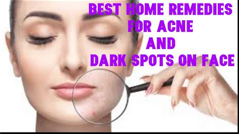 Best Home Remedies For Acne And Dark Spots On Face Youtube