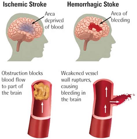 Tipos de accidente cerebrovascular isquémico hemorrágico y AIT