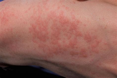 What Causes Rash On Babies Hands