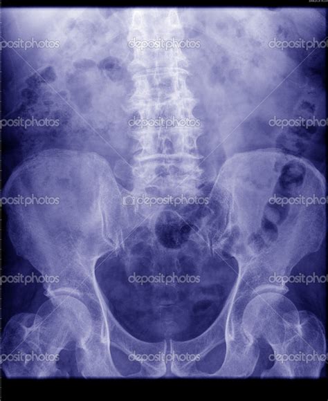 X Ray Of The Abdomen Stock Photo By ©wonderisland 13351244