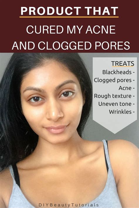 Do clogged pores on cheeks mean unclear skin? Product that DIMINISHED My Acne and Clogged + Enlarged ...