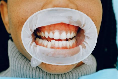 Qué Es La Gingivectomía Causas Tramatiento Y Post Tratamiento