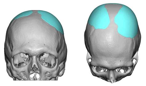 Plastic Surgery Case Study Custom Skull Implant For Skull Contour