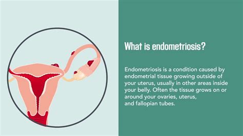 What Is Endometriosis Symptoms Causes Treatment And D