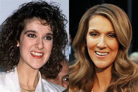 Celine Dion Before And After Thanks To The Dentists Series Dentalscanner Dentists
