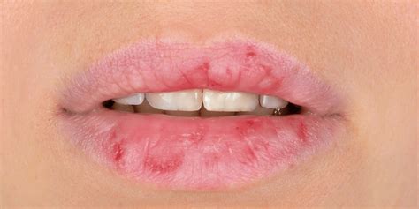 What Causes Continuous Chapped Lips