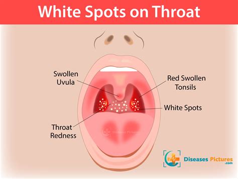 White Spots On Throat Tonsils Causes Symptoms Treatments Healthmd