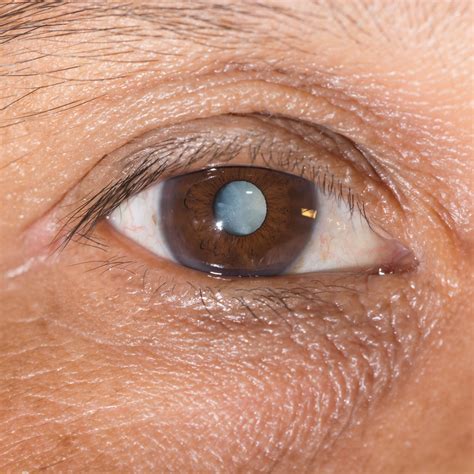 When Is Cataract Surgery Needed Queens Ny
