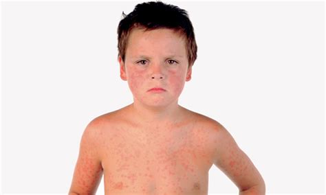 Slapped Cheek Disease Kids Health Time Out Dubai
