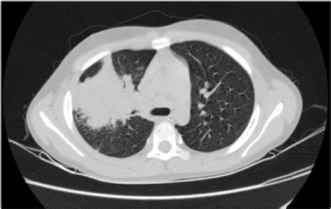 Initial Chest Ct Scan Showing A Consolidation Measuring 22 × 31 × 28mm