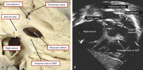 Ventricular Septal Defects Thoracic Key