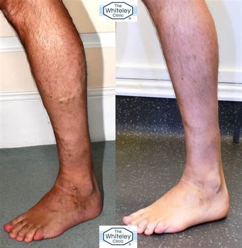Varicose Veins In Men The Whiteley Clinic