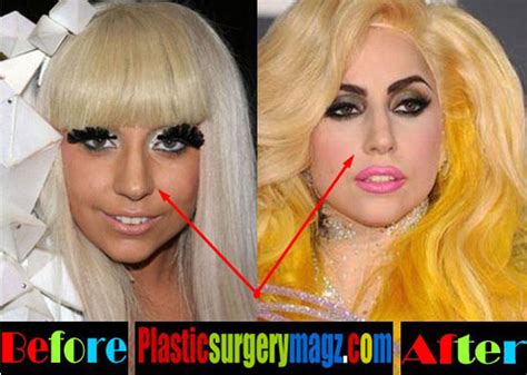 Lady Gaga Plastic Surgery Before After Lady Gaga Surgery 2016