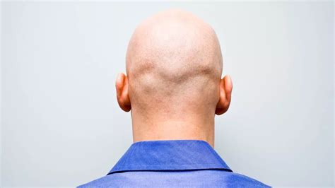 High Court Rules Calling Man Bald Is Harassment Like Commenting On