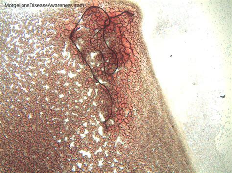 I have the same problem. Morgellons Disease Awareness - Live blood microscopy in a person suffering from Morgellons ...