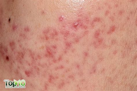 Home Remedies For Candidiasis Of The Skin Cutaneous Candidiasis Top