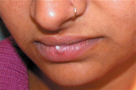 White Patch On Inner Lower Lip Bbsmanager
