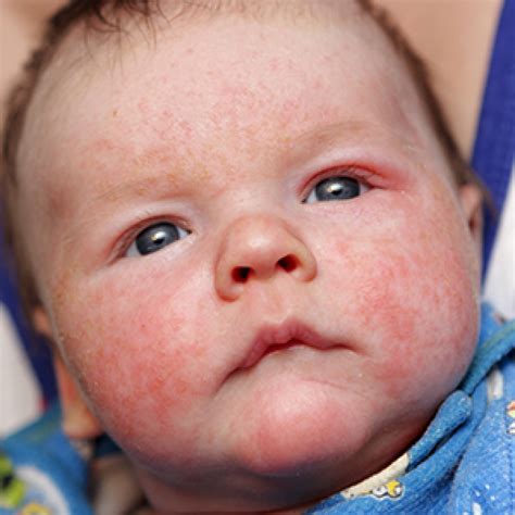Treating Eczema In Babies More Than Just The Skin Holistic Health Blog