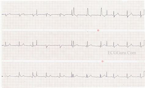 Right Bundle Branch Block With Left Posterior Fascicular Block Ecg