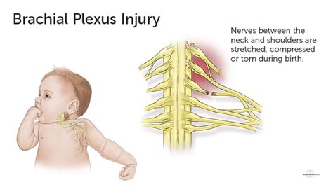 Shoulder Dystocia Erb S Palsy Obsetrical Brachial Plexus Injury How