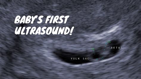 Babys First Ultrasound 6 Weeks Pregnant Youtube