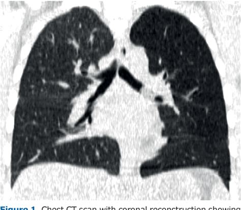 Figure 1 From Unilateral Hyperlucent Lung Semantic Scholar