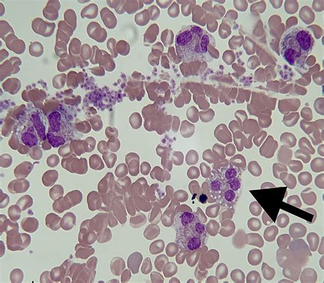 Cureus A Case Of Chronic Eosinophilic Leukemia In A Patient With