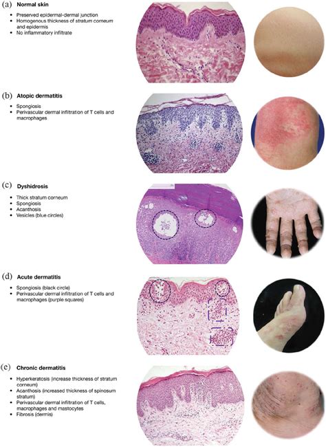 Eczematous Dermatitis Histopathology