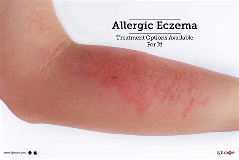 Allergic Eczema Treatment Options Available For It By Dr Ravinder
