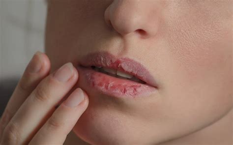 Discolored Or Dry Lips Can Indicate Vitamin Deficiency Dr Berg
