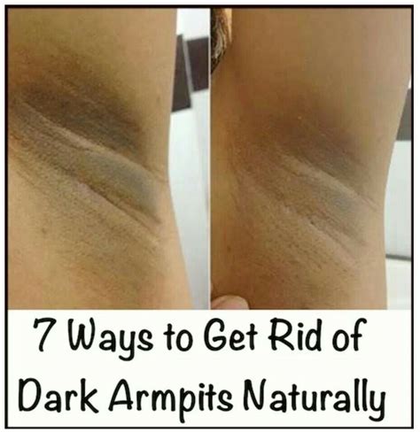Get Rid Of Dark Underarms With These 9 Natural Solutions Alldaychic