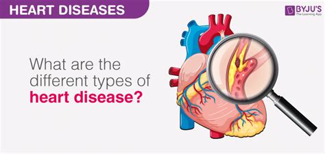 Heart Diseases Types Of Heart Diseases Causes And Treatments